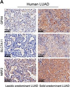 Fig.6.A showing Immunohistochemistry in a Homo sapiens (Human) sample from the publication: IL4I1⁺ Macrophages and TDO2⁺ Myofibroblasts Drive AhR-Mediated Immunosuppression and Ferroptosis Resistance in Solid Predominant Lung Adenocarcinoma.