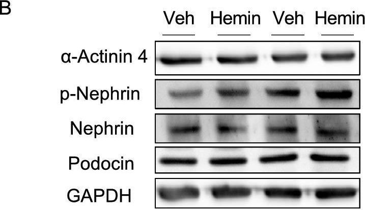 Podocyte dysfunction driven by heme in sickle-cell nephropathy.