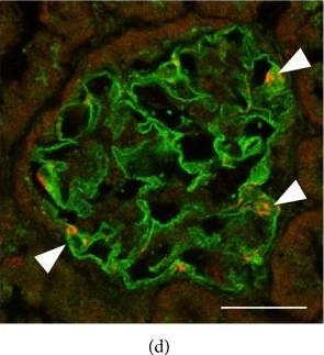 Early-onset diabetic E1-DN mice develop albuminuria and glomerular injury typical of diabetic nephropathy.