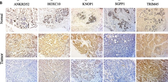 Fig.10.B showing Immunohistochemistry in a Homo sapiens (Human) sample from the publication: Cuproptosis/ferroptosis-related gene signature is correlated with immune infiltration and predict the prognosis for patients with breast cancer.