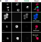 Fig.1.D showing Immunocytochemistry-immunofluorescence from the publication: Circulating tumor cells and clusters as liquid biomarkers for the diagnosis and prognosis of neuroblastoma.