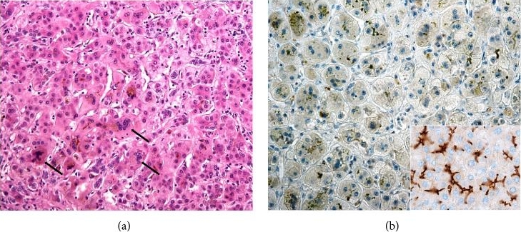 Fig.2.A,B showing Immunohistochemistry in a Homo sapiens (Human) sample from the publication: New Insights in Genetic Cholestasis: From Molecular Mechanisms to Clinical Implications.