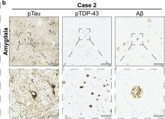 Fig.1.B showing Immunohistochemistry from the publication: CTE-type tau filaments in Alzheimer's disease with co-morbid LATE-NC.
