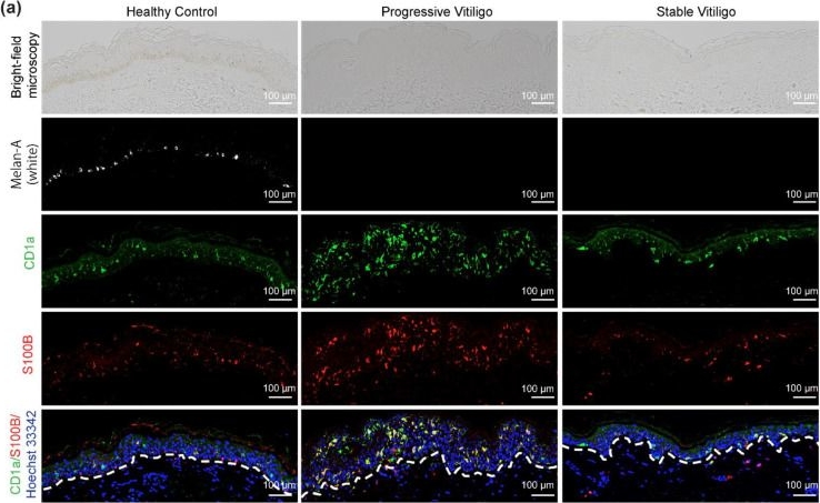 Fig.4.A showing Immunohistochemistry-immunofluorescence from the publication: Morphological Alterations and Increased S100B Expression in Epidermal Langerhans Cells Detected in Skin from Patients with Progressive Vitiligo.