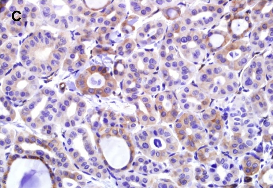 Fig.6.C showing Immunohistochemistry in a Homo sapiens (Human) sample from the publication: Prognostic implication of histological features associated with EHD2 expression in papillary thyroid carcinoma.
