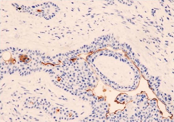 Fig.2.A showing Immunohistochemistry in a Homo sapiens (Human) sample from the publication: CD133 expression in normal skin and in epithelial cutaneous tumors.