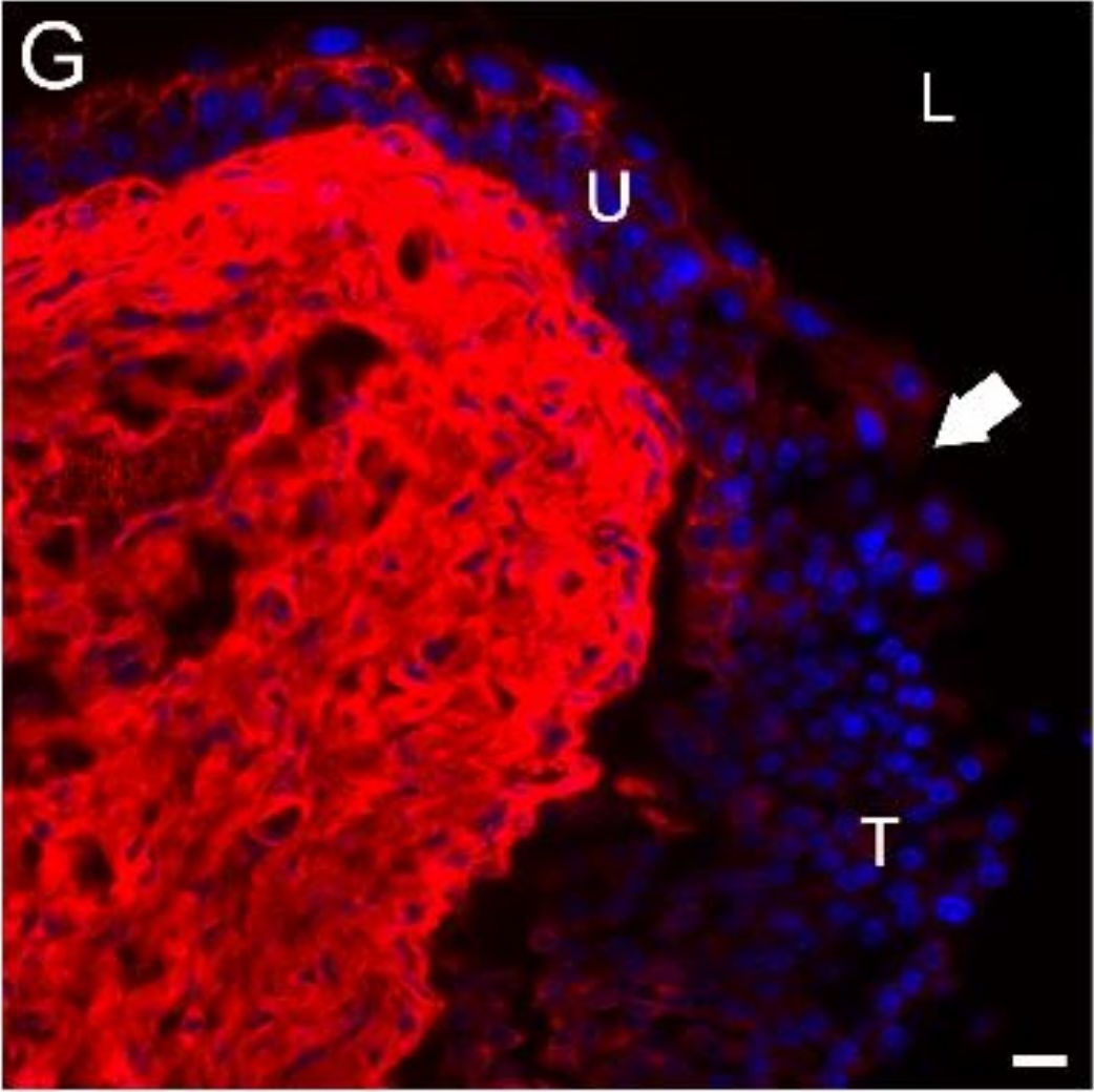 How Cancer Cells Invade Bladder Epithelium and Form Tumors: The Mouse Bladder Tumor Model as a Model of Tumor Recurrence in Patients.