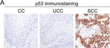 Fig.4.A showing Immunohistochemistry in a Homo sapiens (Human) sample from the publication: Genetic Landscape of Oral Carcinoma Cuniculatum and its Histological Mimics.