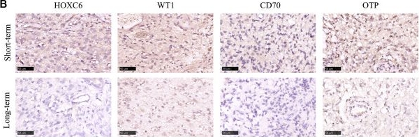 Fig.7.B showing Immunohistochemistry in a Homo sapiens (Human) sample from the publication: Predicting the prognosis of glioma patients with TERT promoter mutations and guiding the specific immune profile of immune checkpoint blockade therapy.