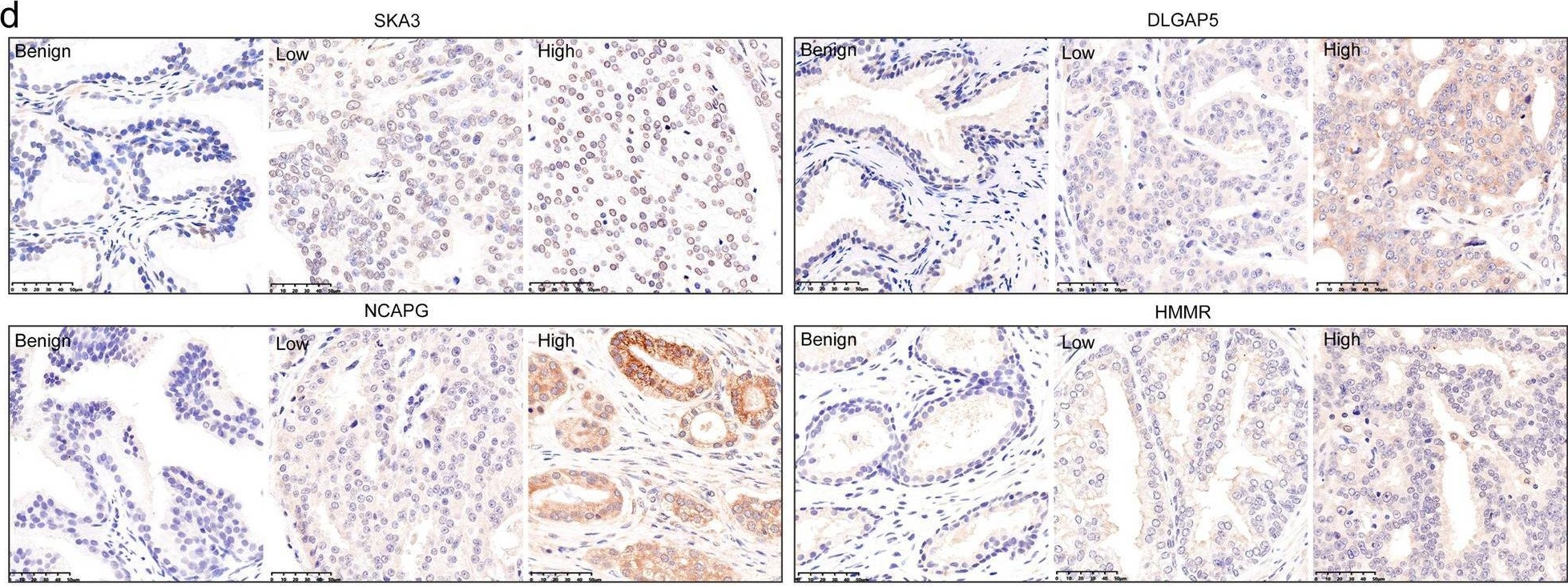 Fig.5.D showing Immunohistochemistry in a Homo sapiens (Human) sample from the publication: Integrative multi-omics analysis unveils stemness-associated molecular subtypes in prostate cancer and pan-cancer: prognostic and therapeutic significance.
