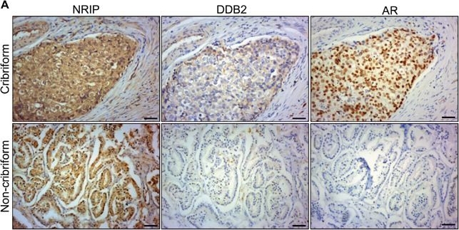 Fig.6.A showing Immunohistochemistry in a Homo sapiens (Human) sample from the publication: NRIP/DCAF6 stabilizes the androgen receptor protein by displacing DDB2 from the CUL4A-DDB1 E3 ligase complex in prostate cancer.