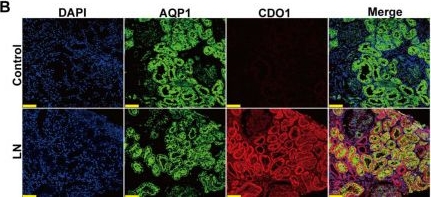 Fig.1.B showing Immunohistochemistry-immunofluorescence in a Homo sapiens (Human) sample from the publication: The CDO1-ACSM3 Axis Mediates Renal Tubule Lipid Deposition and Injury by Causing Mitochondrial Dysfunction in Lupus Nephritis.