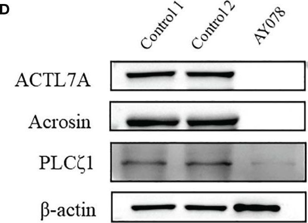Fig.5.D showing Western Blotting from the publication: Novel HYDIN variants associated with male infertility in two Chinese families.