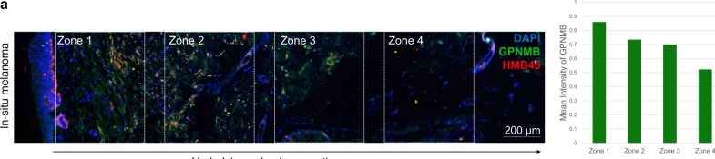 Fig.3.A showing Immunohistochemistry-immunofluorescence from the publication: Classification of node-positive melanomas into prognostic subgroups using keratin, immune, and melanogenesis expression patterns.