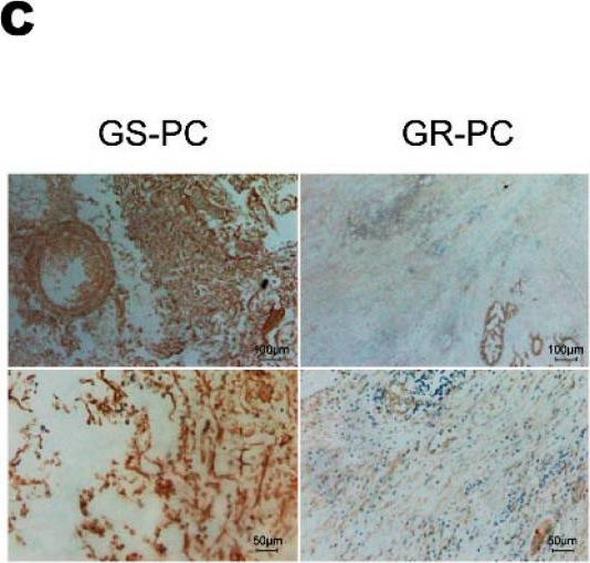Fig.5.C showing Immunohistochemistry in a Homo sapiens (Human) sample from the publication: LncRNA SNHG6 Upregulates KPNA5 to Overcome Gemcitabine Resistance in Pancreatic Cancer via Sponging miR-944.