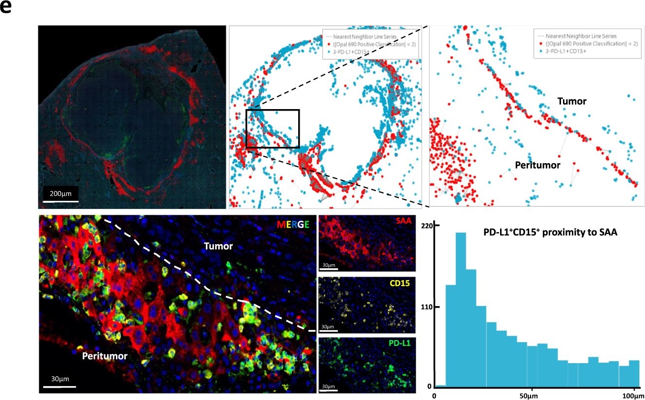 Fig.2.E showing Immunohistochemistry-immunofluorescence from the publication: Serum amyloid A promotes glycolysis of neutrophils during PD-1 blockade resistance in hepatocellular carcinoma.