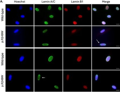 Fig.2.A showing Immunocytochemistry-immunofluorescence from the publication: The p.R249W Mutation in LMNA-Related Congenital Muscular Dystrophy Causes Nuclear Deformities and an Enrichment in Lamin A/C at the Ends of the Nucleus.