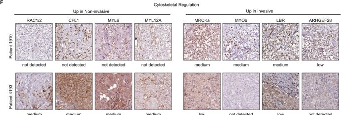 Fig.3.F showing Immunohistochemistry in a Homo sapiens (Human) sample from the publication: Divergent iron regulatory states contribute to heterogeneity in breast cancer aggressiveness.