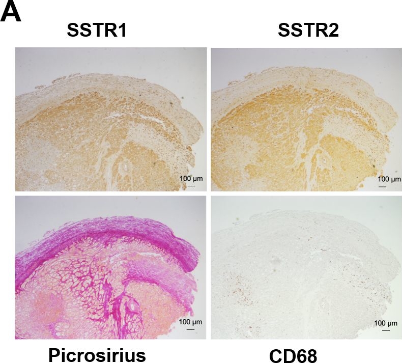 Fig.6.A showing Immunohistochemistry in a Homo sapiens (Human) sample from the publication: Somatostatin receptors in fibrotic myocardium.