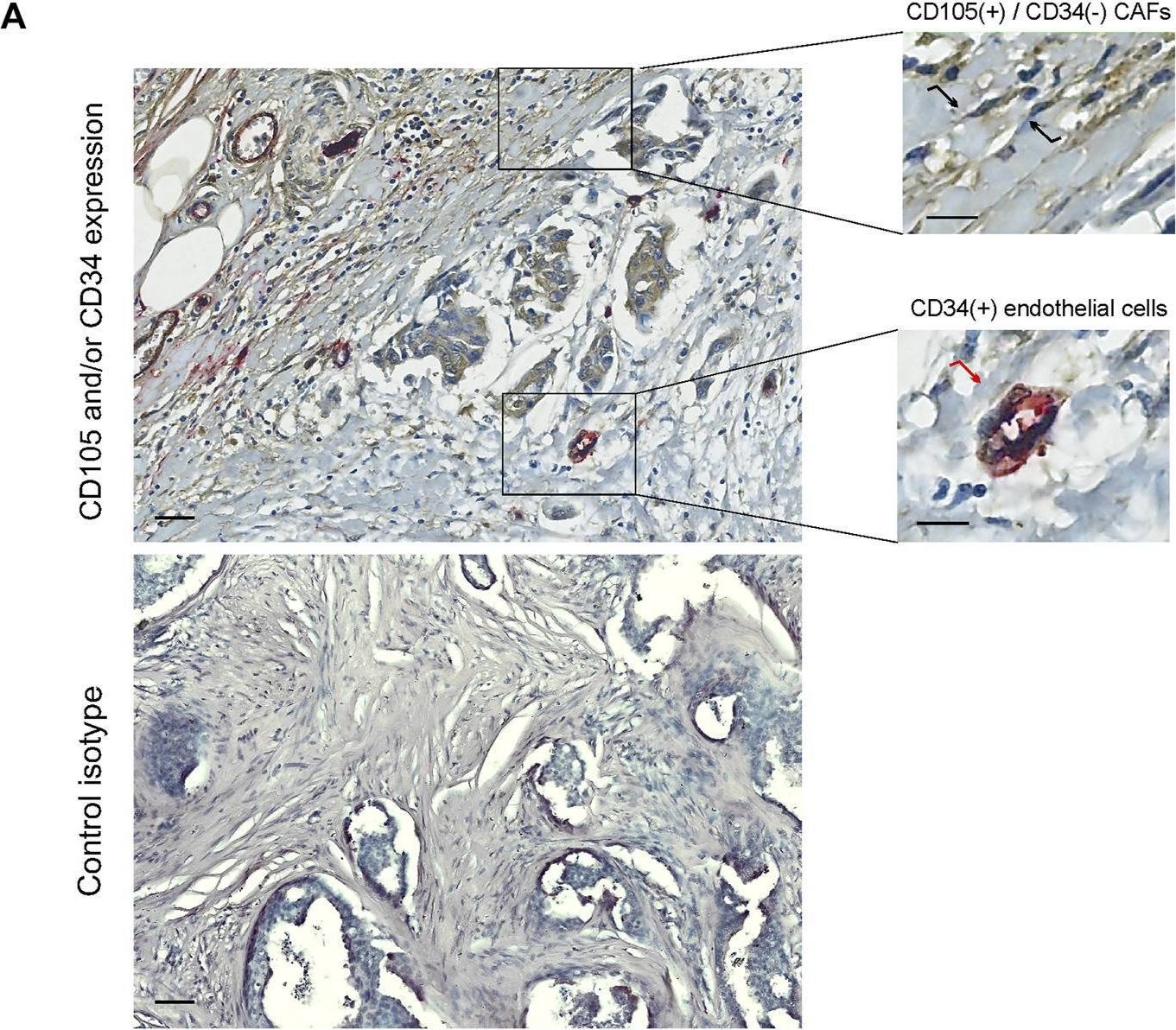 Fig.1.A showing Immunohistochemistry in a Homo sapiens (Human) sample from the publication: CD105 expression in cancer-associated fibroblasts: a biomarker for bone metastasis in early invasive ductal breast cancer patients.