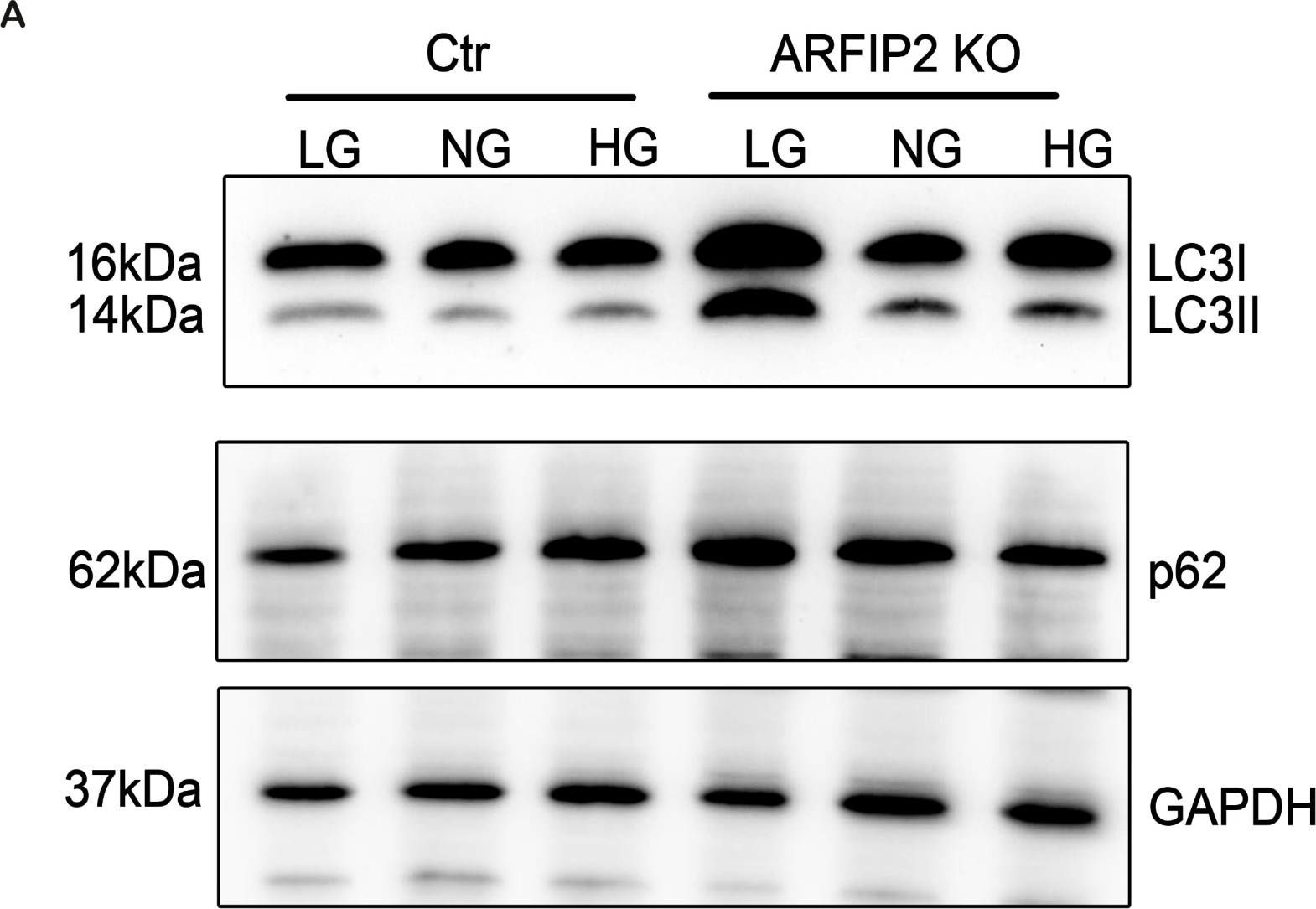 ADP-Ribosylation Factor-Interacting Protein 2 Acts as a Novel Regulator of Mitophagy and Autophagy in Podocytes in Diabetic Nephropathy.