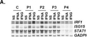 Fig.7.C showing Western Blotting from the publication: Novel STAT1 alleles in otherwise healthy patients with mycobacterial disease.