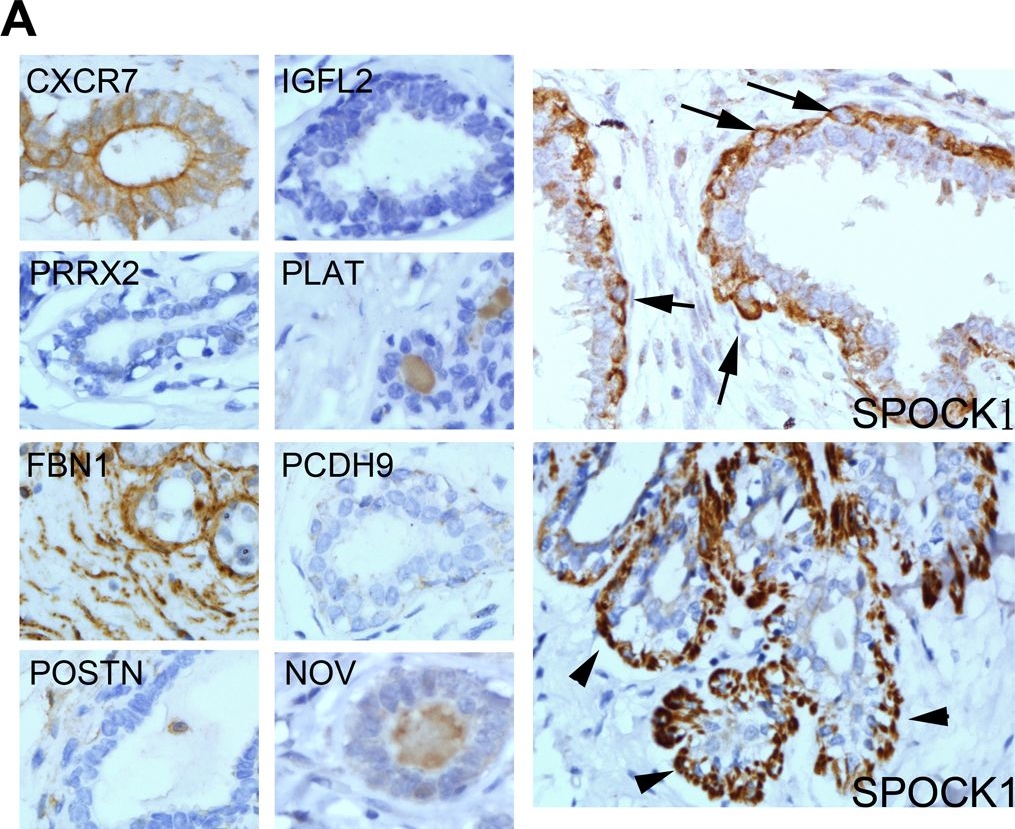 Fig.1.A showing Immunohistochemistry in a Homo sapiens (Human) sample from the publication: SPOCK1 Is a Novel Transforming Growth Factor-β-Induced Myoepithelial Marker That Enhances Invasion and Correlates with Poor Prognosis in Breast Cancer.