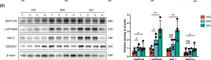 Fig.7.E showing Western Blotting in a Homo sapiens (Human) sample from the publication: Integrated whole-exome and bulk transcriptome sequencing delineates the dynamic evolution from preneoplasia to invasive lung adenocarcinoma featured with ground-glass nodules.
