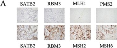 Fig.2.A showing Immunohistochemistry from the publication: Delineating the intra-patient heterogeneity of molecular alterations in treatment-naïve colorectal cancer with peritoneal carcinomatosis.