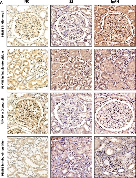 Fig.6.A showing Immunohistochemistry from the publication: Exploring the crosstalk molecular mechanisms between IgA nephropathy and Sjögren's syndrome based on comprehensive bioinformatics and immunohistochemical analyses.