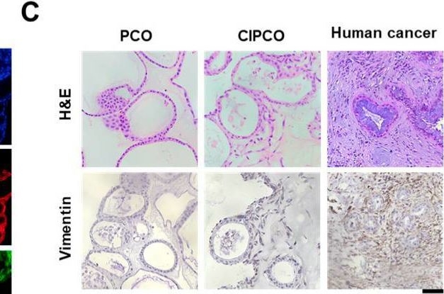 Fig.1.C showing Immunohistochemistry in a Homo sapiens (Human) sample from the publication: Modeling Pancreatic Cancer with Patient-Derived Organoids Integrating Cancer-Associated Fibroblasts.