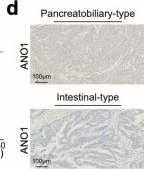 Fig.5.D showing Immunohistochemistry from the publication: Integrated proteogenomic characterization of ampullary adenocarcinoma.