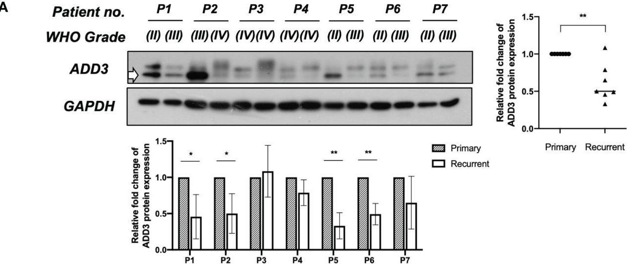 Fig.3.A showing Western Blotting from the publication: ADD3 Deletion in Glioblastoma Predicts Disease Status and Survival.