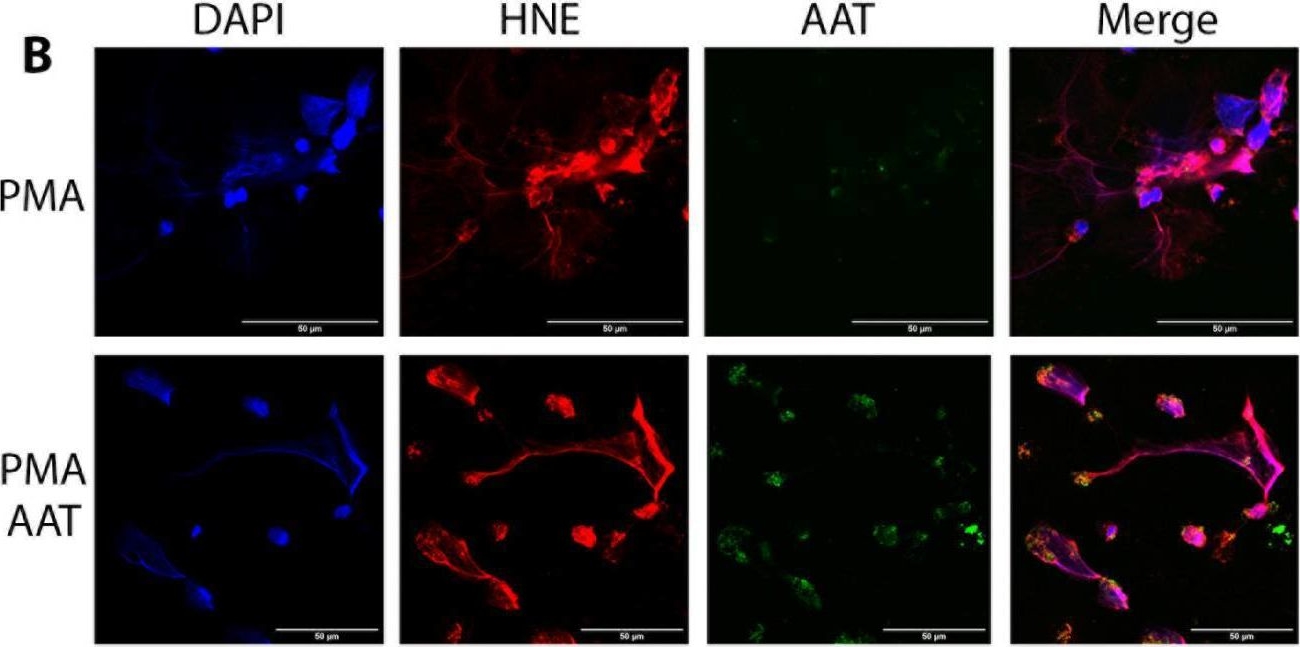 Fig.4.B showing Immunohistochemistry-immunofluorescence from the publication: Investigating the Link between Alpha-1 Antitrypsin and Human Neutrophil Elastase in Bronchoalveolar Lavage Fluid of COVID-19 Patients.