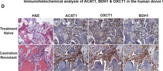 Fig.5.D showing Immunohistochemistry from the publication: Prostate cancer castrate resistant progression usage of non-canonical androgen receptor signaling and ketone body fuel.