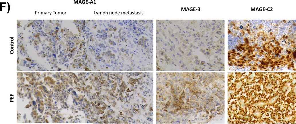 Fig.7.F showing Immunohistochemistry in a Homo sapiens (Human) sample from the publication: Pulsed electric field induces exocytosis and overexpression of MAGE antigens in melanoma.