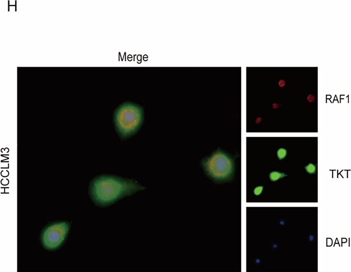Fig.3.H showing Immunocytochemistry-immunofluorescence in a Homo sapiens (Human) sample from the publication: A positive feedback loop between TKT and c-Myc drives TACE resistance in hepatocellular carcinoma.