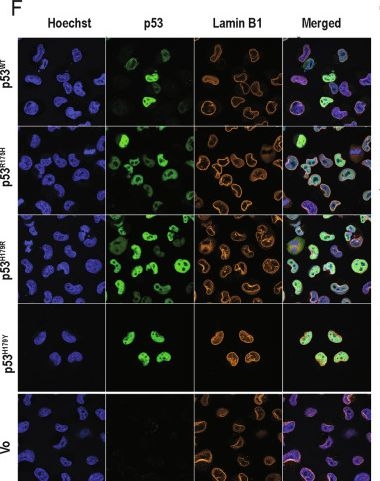 Fig.2.F showing Immunocytochemistry-immunofluorescence in a Homo sapiens (Human) sample from the publication: TP53 mutation at codon 179 metabolically reprograms cancer cells to promote invasion.