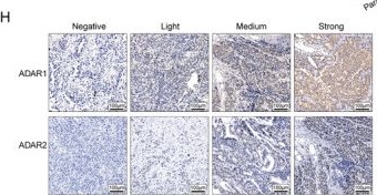 Fig.1.H showing Immunohistochemistry from the publication: Inhibiting ADAR1-Mediated Excessive Epigenetic A-to-I RNA Editing Improves the Immune Microenvironment and Increases Sensitivity to Immunotherapy in Lung Adenocarcinoma.