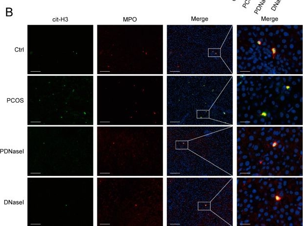 Fig.3.B showing Immunocytochemistry-immunofluorescence from the publication: Metabolic Implications of Elevated Neutrophil Extracellular Traps in Polycystic Ovary Syndrome: A Focus on Hepatic Glycolysis.