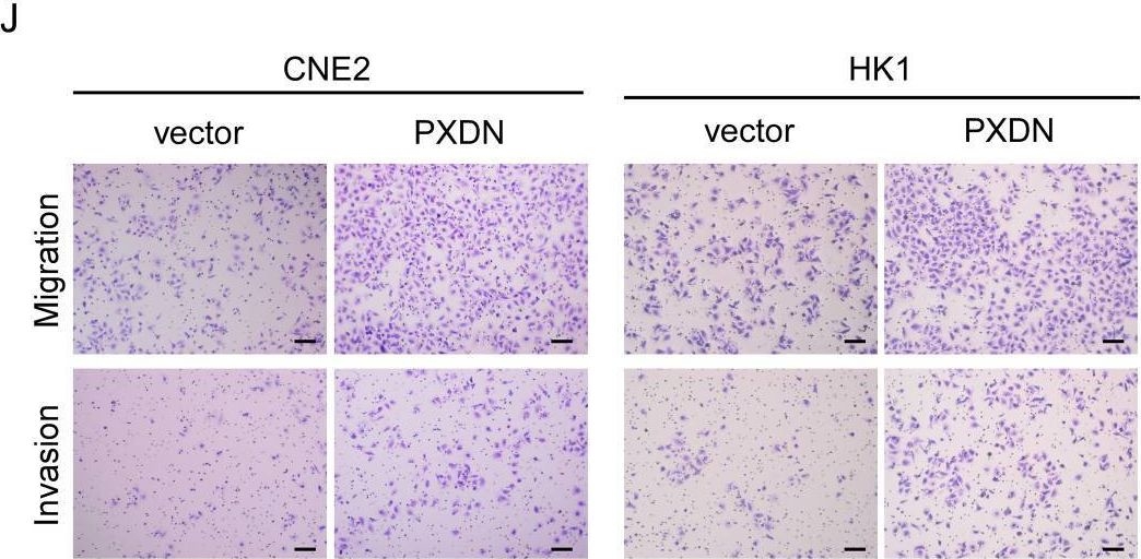 Fig.5.J showing Immunohistochemistry in a Homo sapiens (Human) sample from the publication: PXDN as a pan-cancer biomarker and promotes tumor progress via immune inhibition in nasopharyngeal carcinoma.