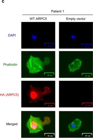 Fig.5.C showing Immunocytochemistry-immunofluorescence in a Homo sapiens (Human) sample from the publication: Inherited ARPC5 mutations cause an actinopathy impairing cell motility and disrupting cytokine signaling.