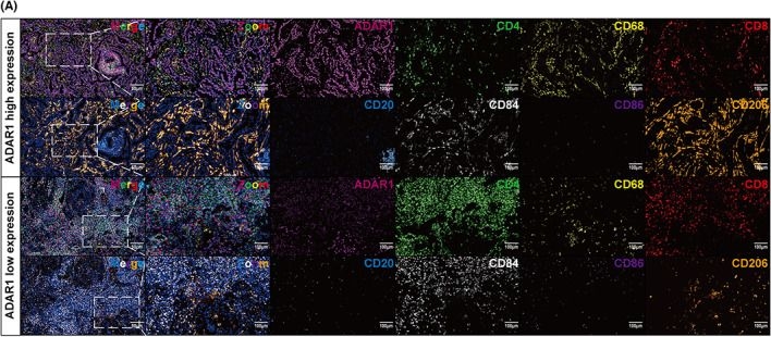 Fig.5.A showing Immunohistochemistry-immunofluorescence in a Homo sapiens (Human) sample from the publication: ADAR1 is a prognostic biomarker and is correlated with immune infiltration in lung adenocarcinoma.
