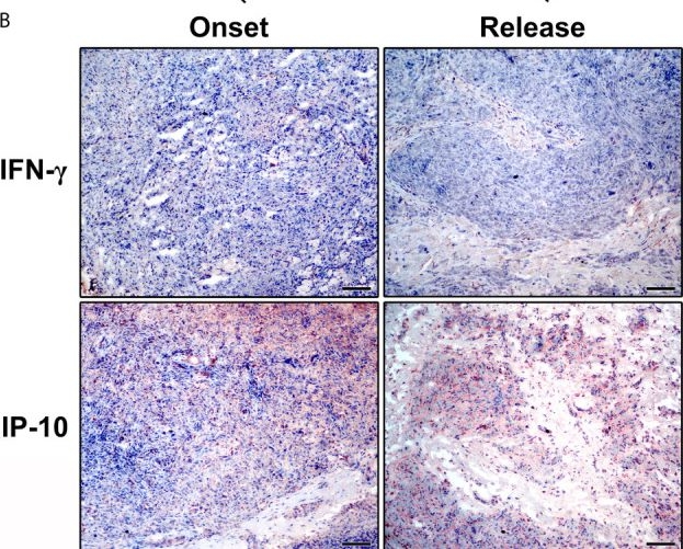 Fig.3.B showing Immunohistochemistry from the publication: Potential Role of CXCL10 in Monitoring Response to Treatment in Leprosy Patients.